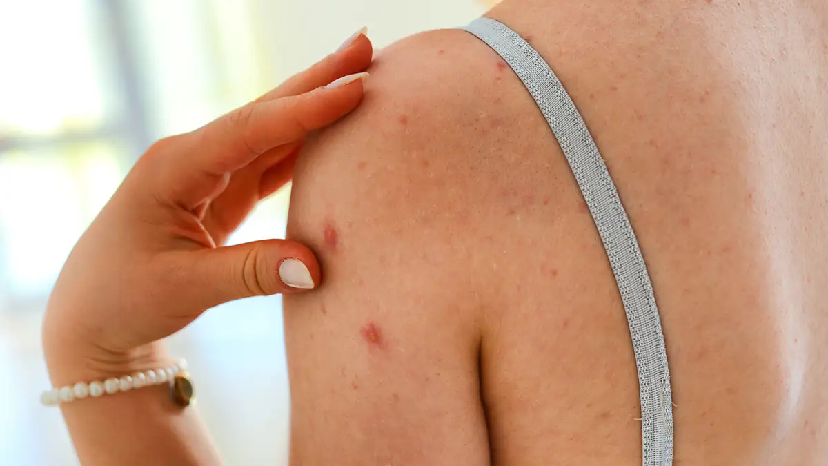 How to get rid of body acne, according to Dr. Pimple Popper - Reviewed