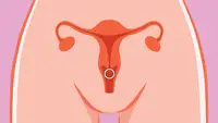 Infographic of hormonal birth control ring inserted into cartoon uterus.