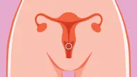 Infographic of hormonal birth control ring inserted into cartoon uterus.