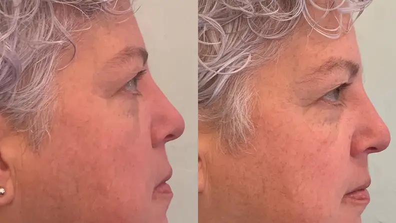 The side of the author's face before and after using the La Mer Eye Balm Intense.