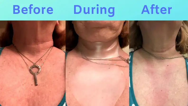 Three images showing Sue's chest: Before SiO, during SiO with patches applied, and after SiO