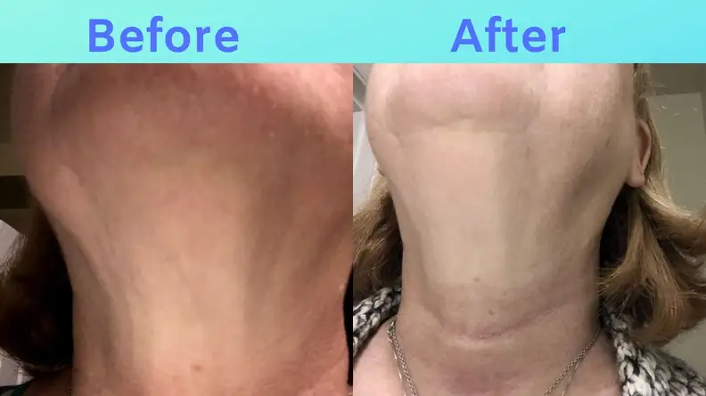Side-by-side images of Sue's neck before and after SiO