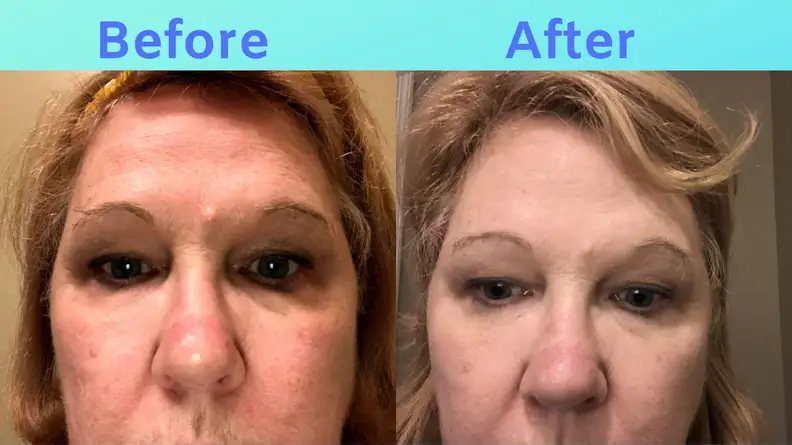 Side-by-side images of Sue's forehead before and after SiO