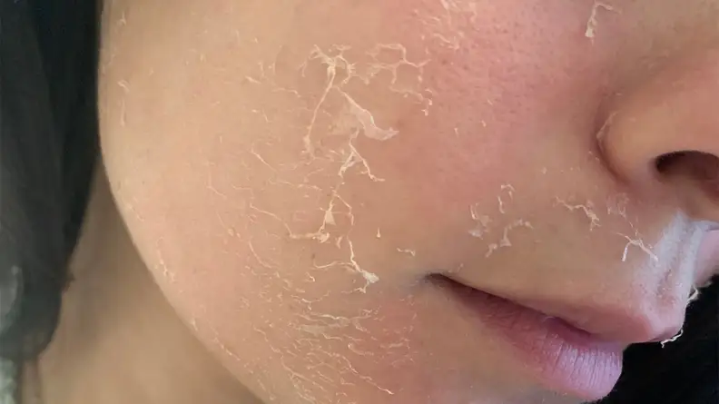 A closeup on the offers cheek showing her skin peeling.