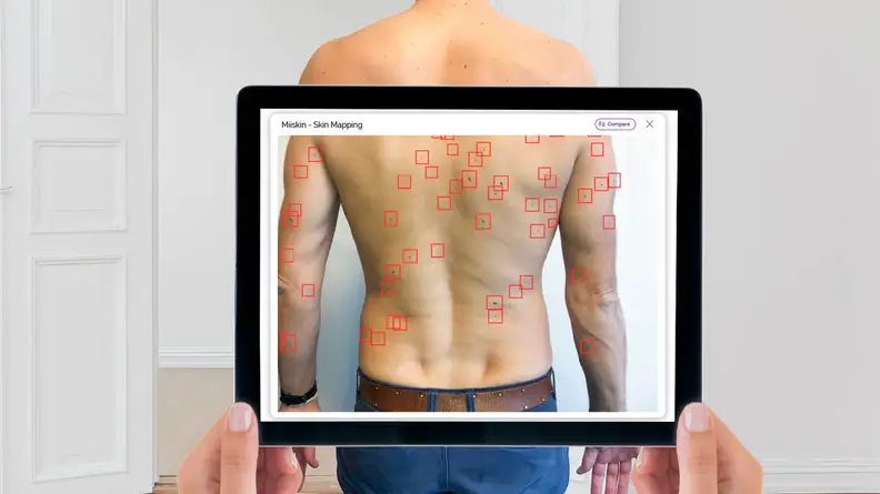 A person uses the MiiSkin app to examine another individual's bare back.