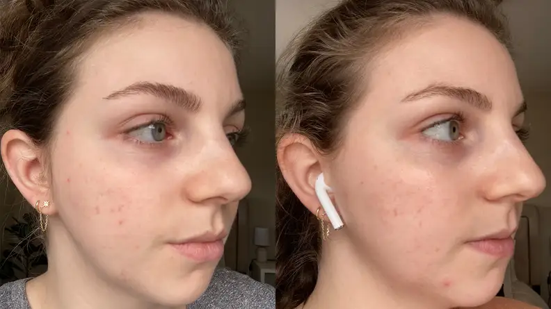 A side by side image of the right side of the author's face, showing more redness on the cheeks in the left image.