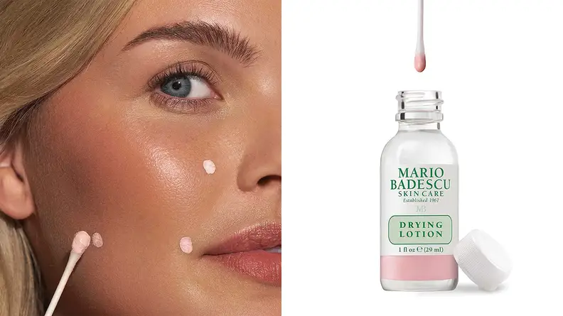 On the left: A person using a cotton swab to apply pink acne lotion to their face. On the right: A clear bottle of acne solution with a cotton swab above it.