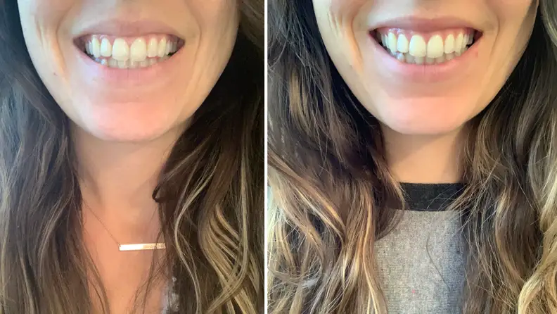 Before and after - Active Wow Teeth Whitening Charcoal Powder Natural