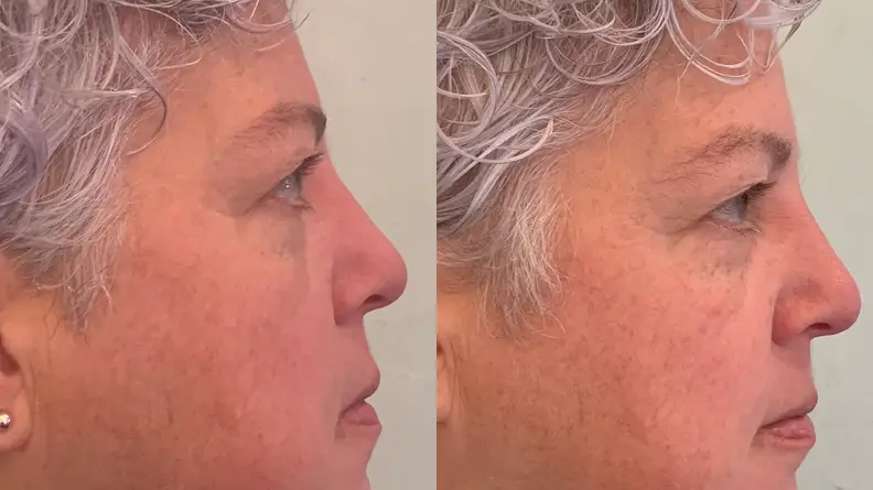 The side of the author's face before and after using the La Mer Eye Balm Intense.