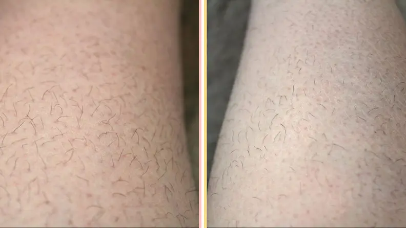 Before and after pictures for the Lumi permanent hair removal device.