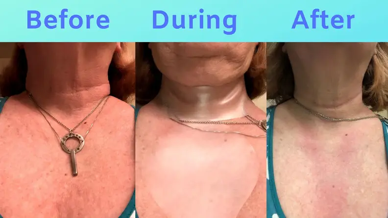 Three images showing Sue's chest: Before SiO, during SiO with patches applied, and after SiO