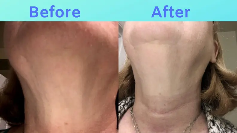 Side-by-side images of Sue's neck before and after SiO