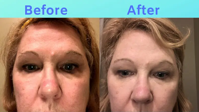 Side-by-side images of Sue's forehead before and after SiO