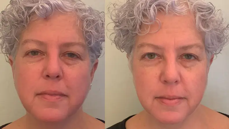 The author's face before and after using the La Mer Eye Balm Intense.