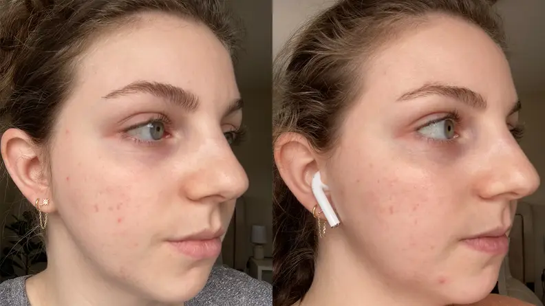 A side by side image of the right side of the author's face, showing more redness on the cheeks in the left image.