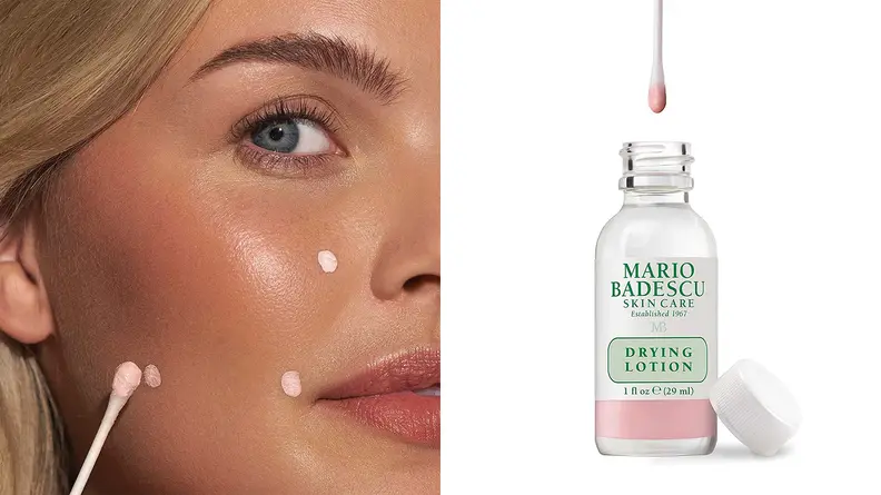 On the left: A person using a cotton swab to apply pink acne lotion to their face. On the right: A clear bottle of acne solution with a cotton swab above it.