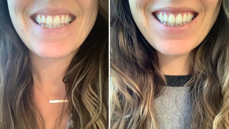 Before and after - Active Wow Teeth Whitening Charcoal Powder Natural